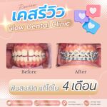 เคสรีวิว รีวิวจัดฟัน