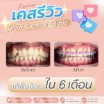 เคสรีวิว รีวิวจัดฟัน