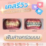 เคสรีวิว รีวิวจัดฟัน