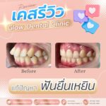 เคสรีวิว รีวิวจัดฟัน