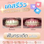 เคสรีวิว รีวิวจัดฟัน