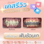 เคสรีวิว รีวิวจัดฟัน