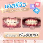 เคสรีวิว รีวิวจัดฟัน