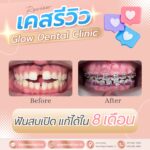 เคสรีวิว รีวิวจัดฟัน