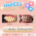 เคสรีวิว รีวิวจัดฟัน
