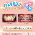 เคสรีวิว รีวิวจัดฟัน
