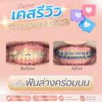 เคสรีวิว รีวิวจัดฟัน