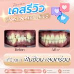 เคสรีวิว รีวิวจัดฟัน