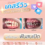 เคสรีวิว รีวิวจัดฟัน