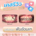 เคสรีวิว รีวิวจัดฟัน