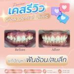 เคสรีวิว รีวิวจัดฟัน