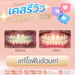 เคสรีวิว รีวิวจัดฟัน