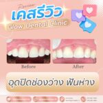 เคสรีวิว รีวิวอุดฟัน