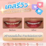 เคสรีวิว รีวิวอุดฟัน