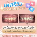เคสรีวิว รีวิวจัดฟัน