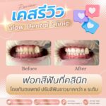 เคสรีวิว รีวิวฟอกสีฟัน