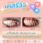 เคสรีวิว รีวิวจัดฟัน