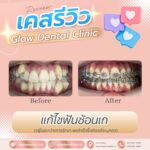 เคสรีวิว รีวิวจัดฟัน