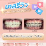 เคสรีวิว รีวิวจัดฟัน