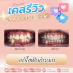 เคสรีวิว รีวิวจัดฟัน