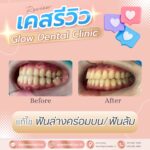เคสรีวิว รีวิวจัดฟัน