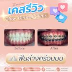 เคสรีวิว รีวิวจัดฟัน