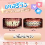 เคสรีวิว รีวิวจัดฟัน