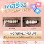 เคสรีวิว รีวิวฟอกสีฟัน