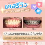 เคสรีวิว รีวิวจัดฟัน