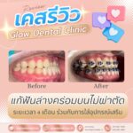 เคสรีวิว รีวิวจัดฟัน