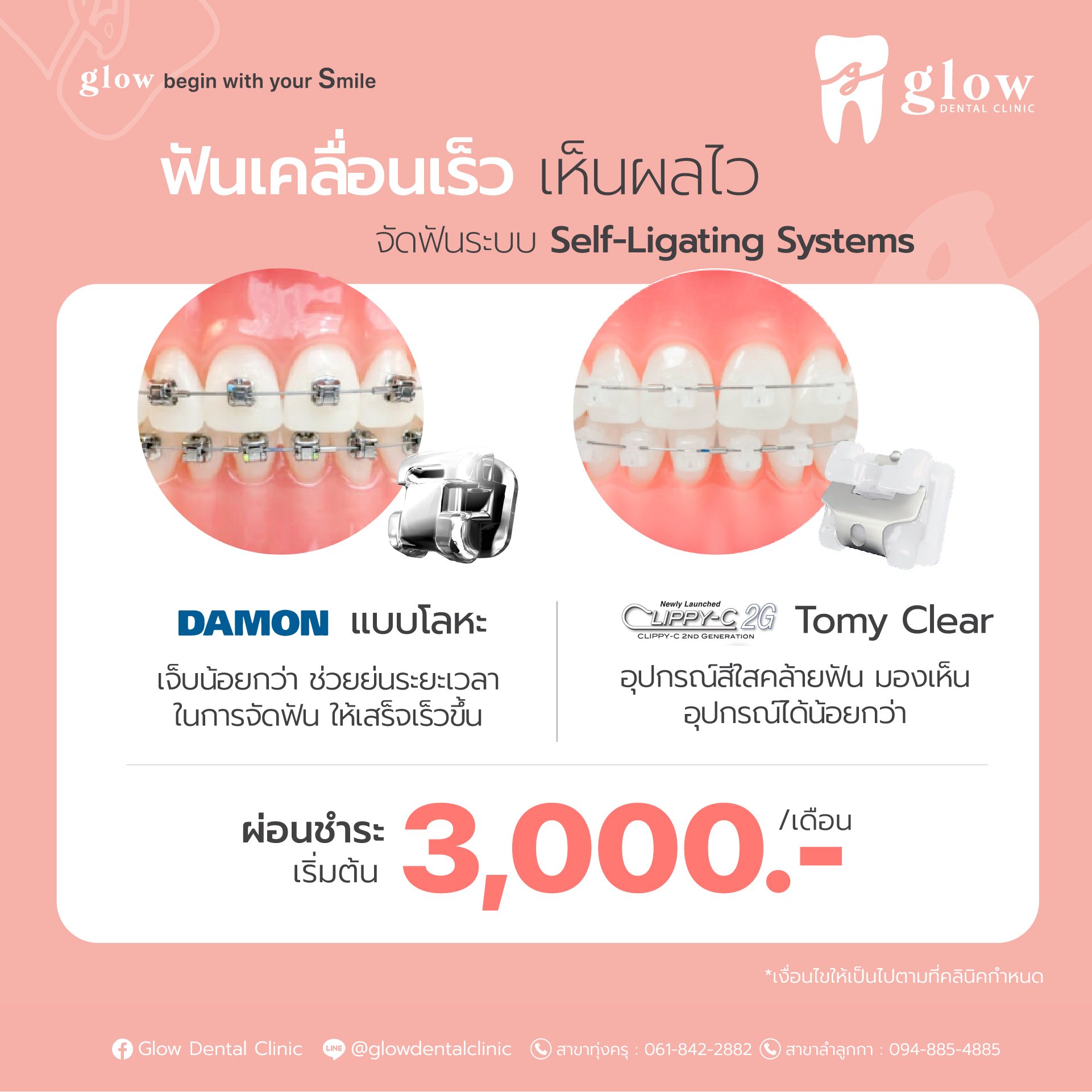 โปรจัดฟันดาม่อน โปรโมชันจัดฟันดาม่อน จัดฟันdamon