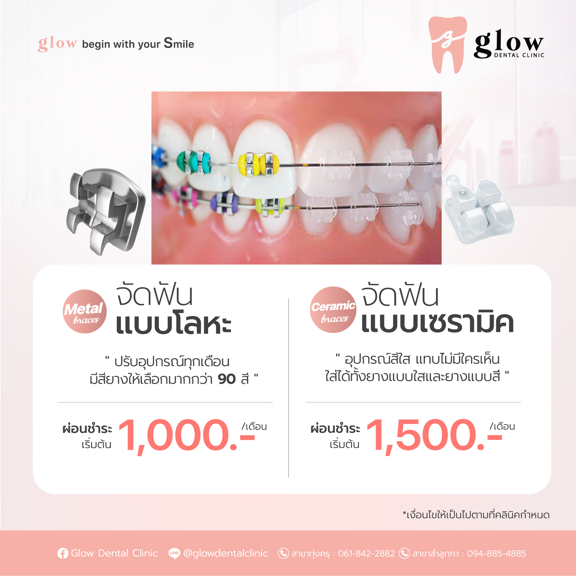 โปรโมชันจัดฟัน จัดฟันโลหะ โปรจัดฟัน จัดฟันเซรามิค จัดฟันเซรามิก ผ่อนชำระเดือนละ 1000 ผ่อนชำระ